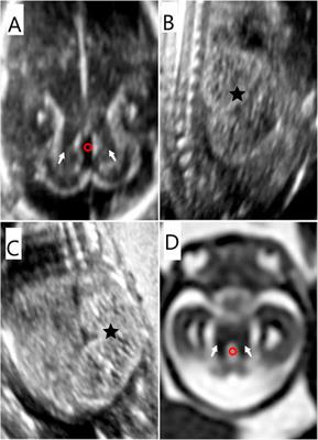 Case report and a brief review: Analysis and challenges of prenatal imaging phenotypes and genotypes in Joubert syndrome